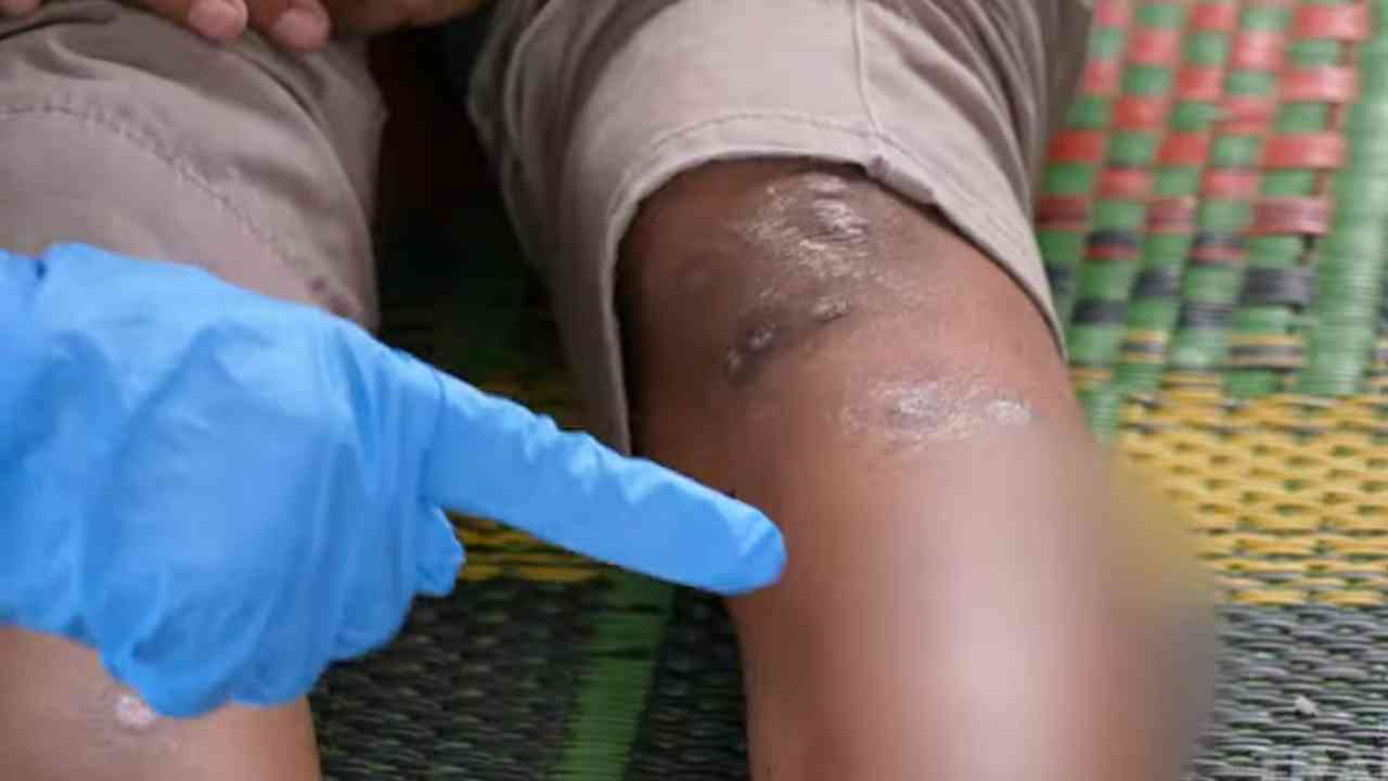 Apa itu Scabies dan Bagaimana Cara Mengobatinya?